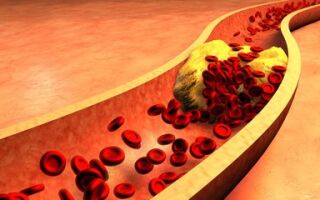 Высокий холестерин: причины повышения и что делать?
