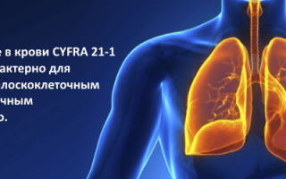 Анализ крови на онкомаркер CYFRA 21-1