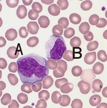Общий анализ крови при инфекционном мононуклеозе thumbnail