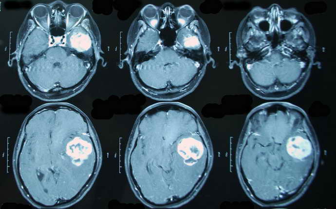 Анализ крови при опухоли головного мозга